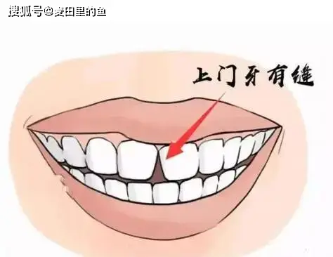 牙齒縫隙大有什么好的方法解決？